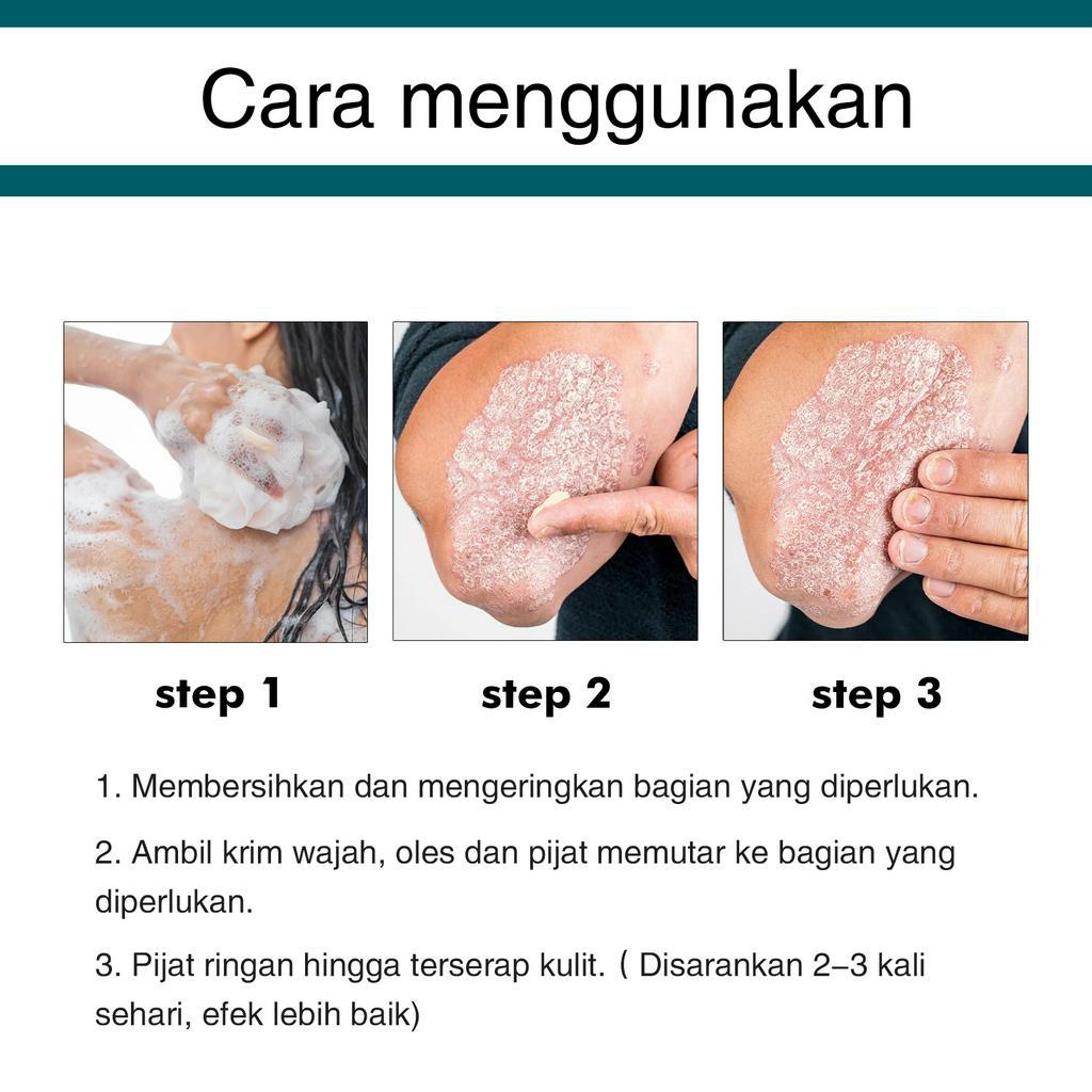 [100% Asli ] Obat gatal kulit Obat gatal paling ampuh Obat gatal selangkangan 30g Bakteriostasis herbal/Eksim membandel/Kulit gatal/Gatal di selangkangan/Krim Antipruritic Seluruh Tubuh