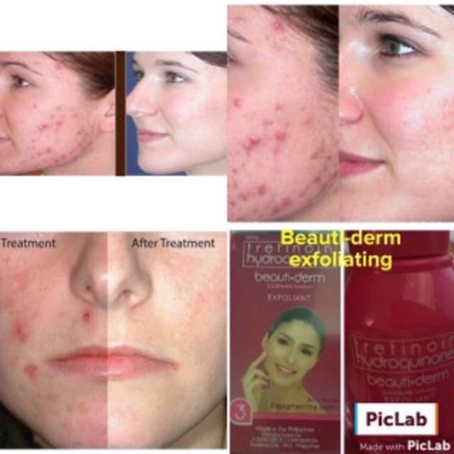 Beauti-derm tretinoin hydroquinone exfoliant anti acne and depigment