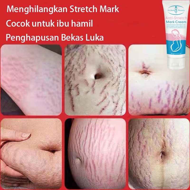 Strechmark cream Penghilang strechmark Penghilang bekas luka Salep penghilang bekas luka Menghilangkan bekas luka yang aman dan efektif untuk ibu hamil