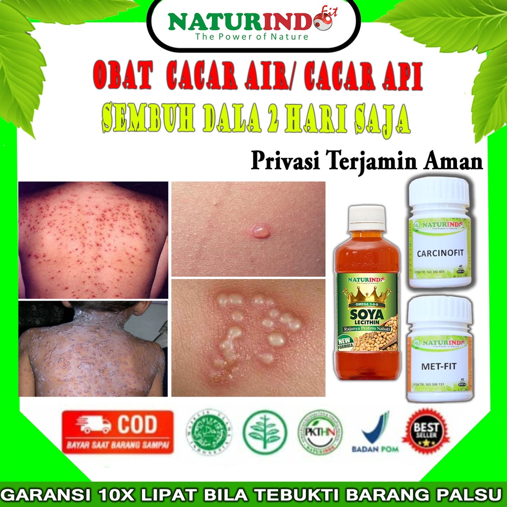 Obat Cacar, Obat Cacar air, Obat Cacar Api, Obat Campak, Obat Gatal Berair, Obat Gatal Gatal, , Obat