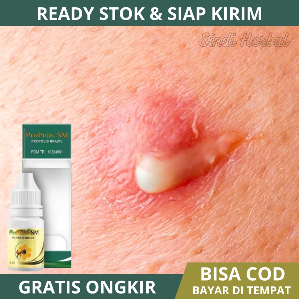 Obat Bisul - Obat Bisul Di Pantat - Obat Bisulan - Obat Bisul Di Kaki - Obat Bisul Di Ketiak - Obat 