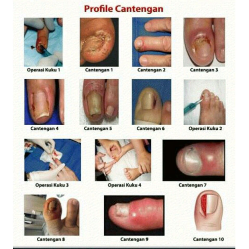 Cara Mengobati Nanah Di Kuku Tangan
