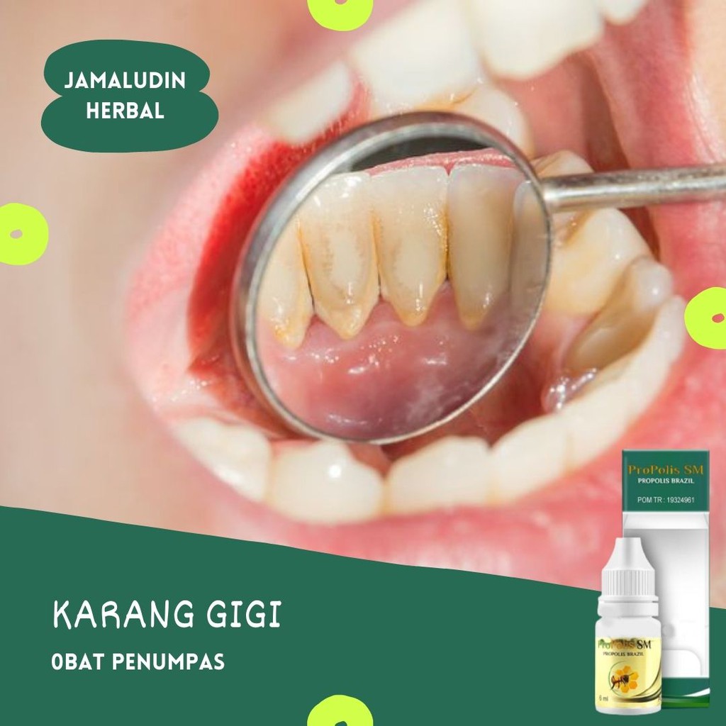Obat Sakit Gigi Herbal - Propolis SM BPOM HALAL
