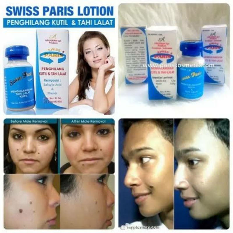 (COD) SWISS PARIS LOTION / PENGHILANG KUTIL , MATA IKAN , TAHI LALAT TANPA OPERASI