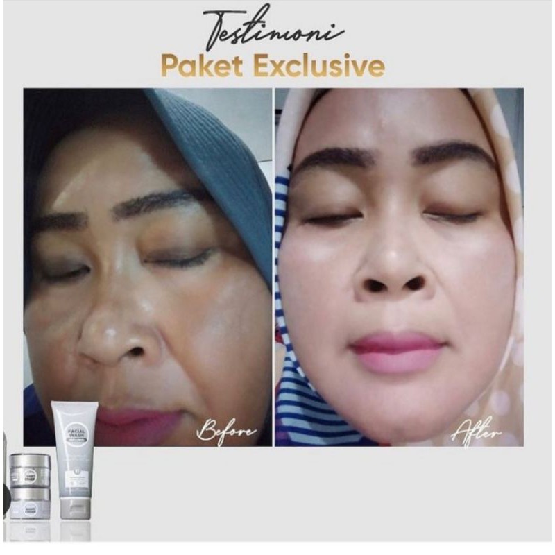 BENINGS skincare paket exclusive (flek hitam) by dr.oky pratama