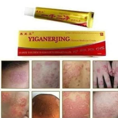 OBAT EKSIM GATEL KULIT JAMUR HERBAL YIGANERJING CREAM GOLD PSORIASIS