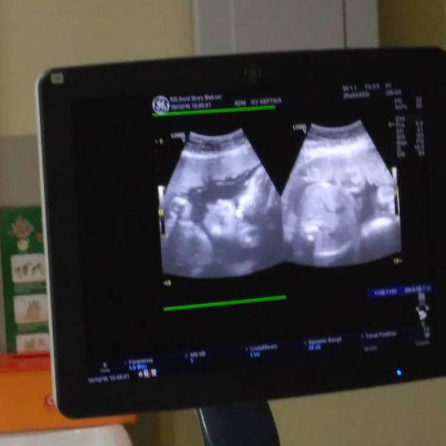 Tabasa Payung Tongkat Anak Transparan Mangkok Snowman