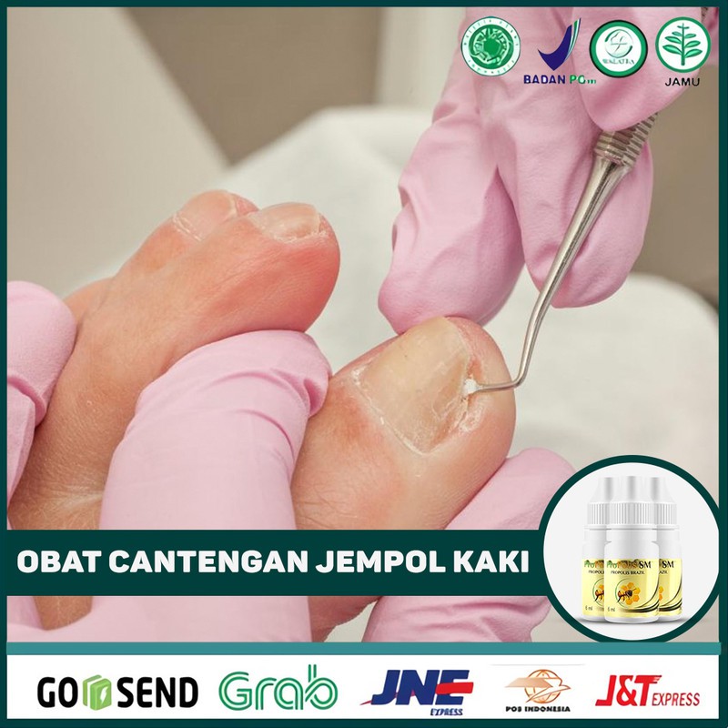 Obat Cantengan Jempol Kaki, Kuku Kaki Bernanah, Kuku Jempol Propolis SM 100% Asli Di Surabaya