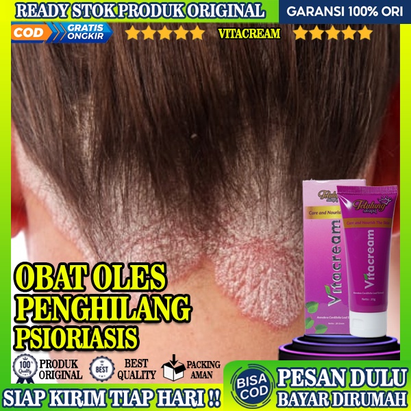 Vitacream Obat Psioriasis, Obat Penghilang Psioriasis, Obat Gatal Kulit Kepala, Obat Kepala Berkerak