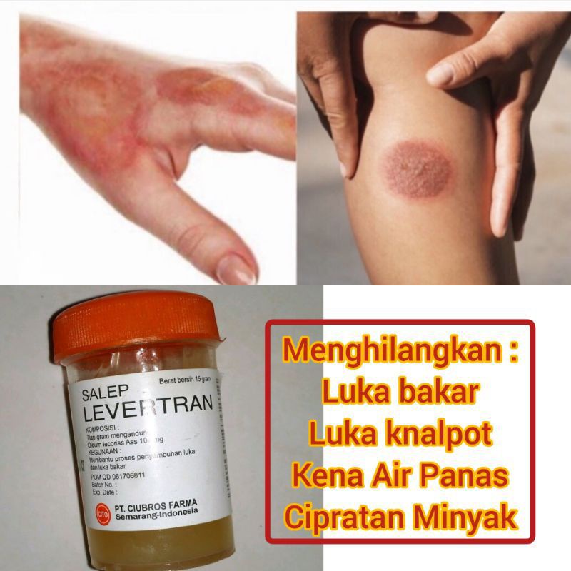 SALEP LEVERTRAN 15GR I SALEP LUKA BAKAR I OBAT LUKA KULIT