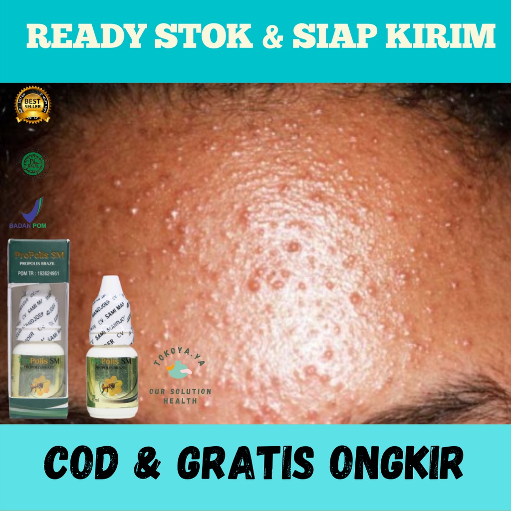Obat Herbal Pembersih Bruntusan di Jidat, Obat Penghilang Bruntusan Di Dahi, Obat Herbal Penghilang 