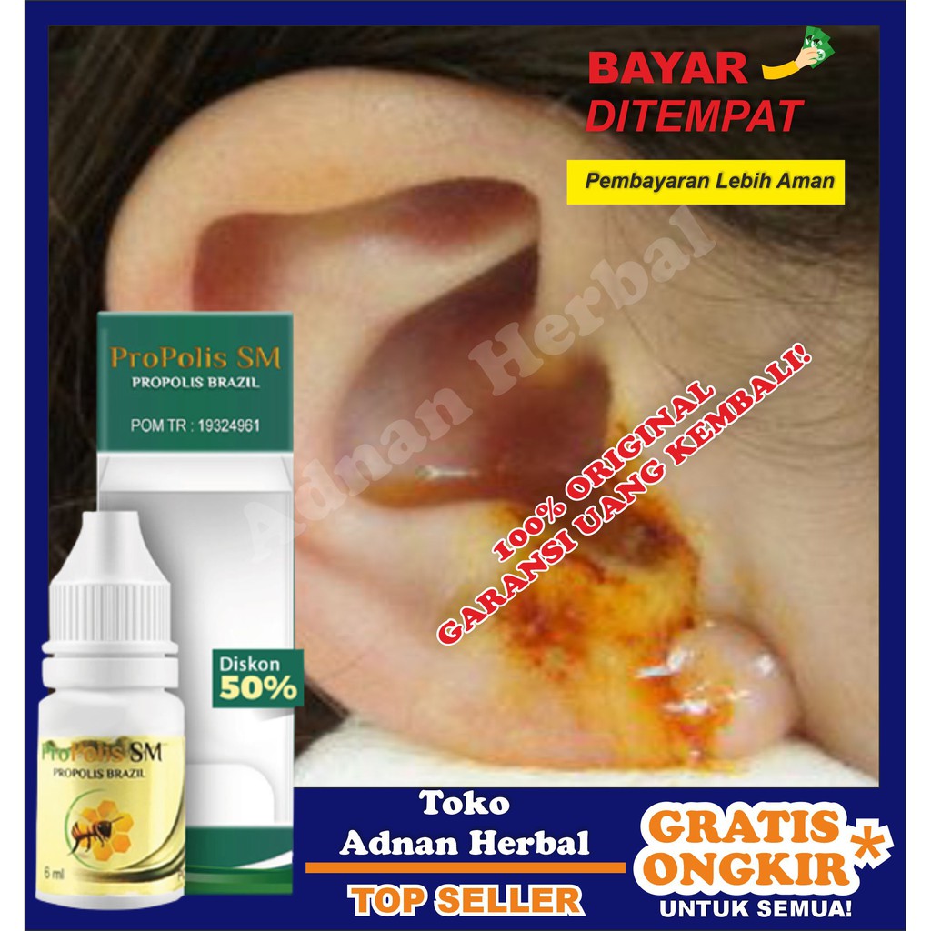 Obat Tetes Sakit Telinga, Telinga Bernanah, Berair, Curek, Congek, Gendang Telinga Bolong