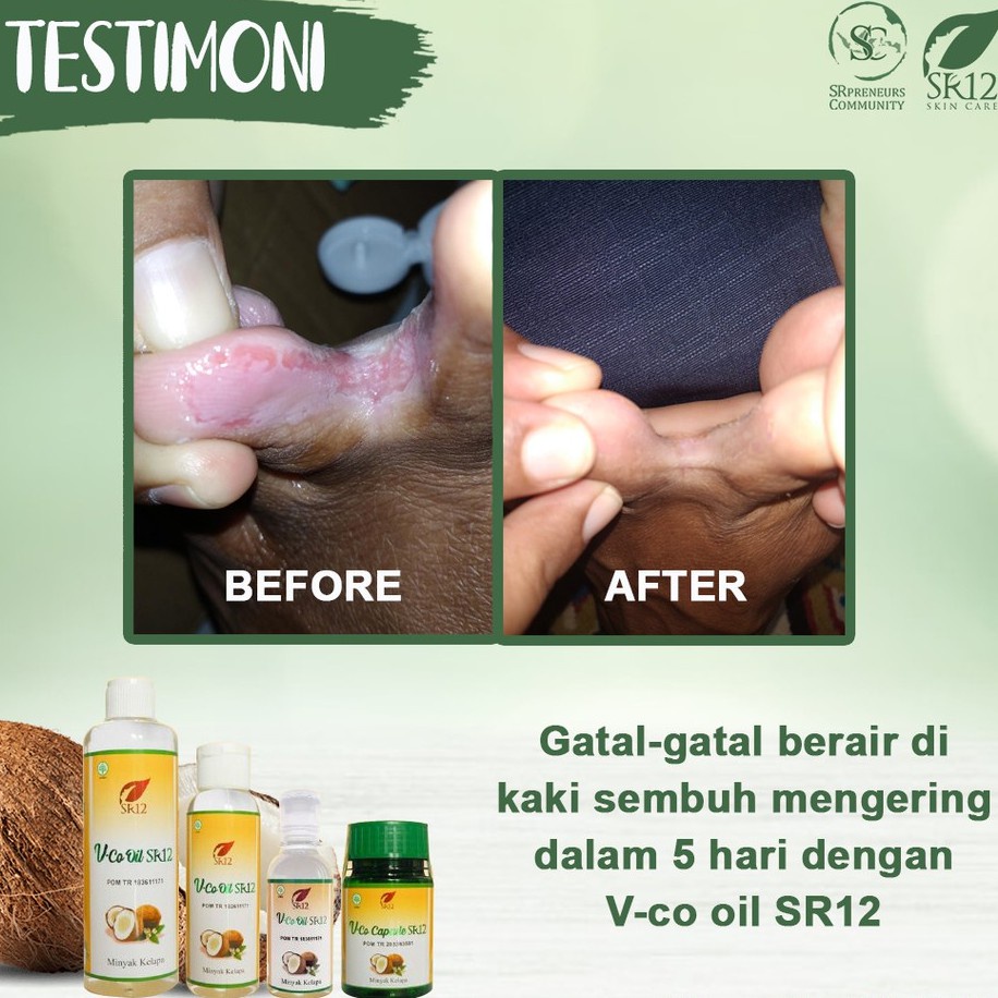 VCO SR12 Virgin Coconut Oil Minyak Kelapa Murni Untuk Bayi Rambut Diet Imun Asi Booster Antioksidan Anti Aging Kecantikan Dan Kesehatan