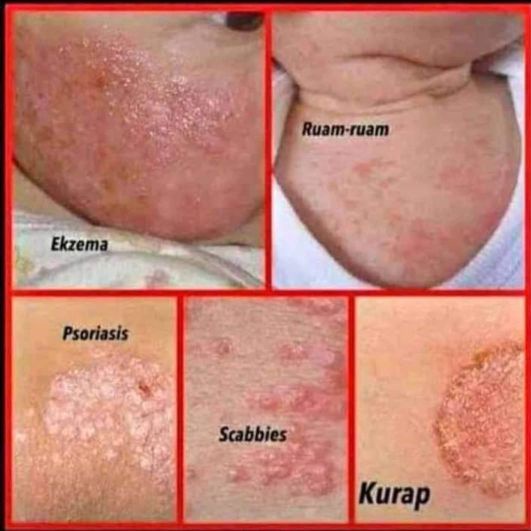 Salep GTL Original 100% Asli Gatel Usir Kudis Kurap Panu Korengan-6