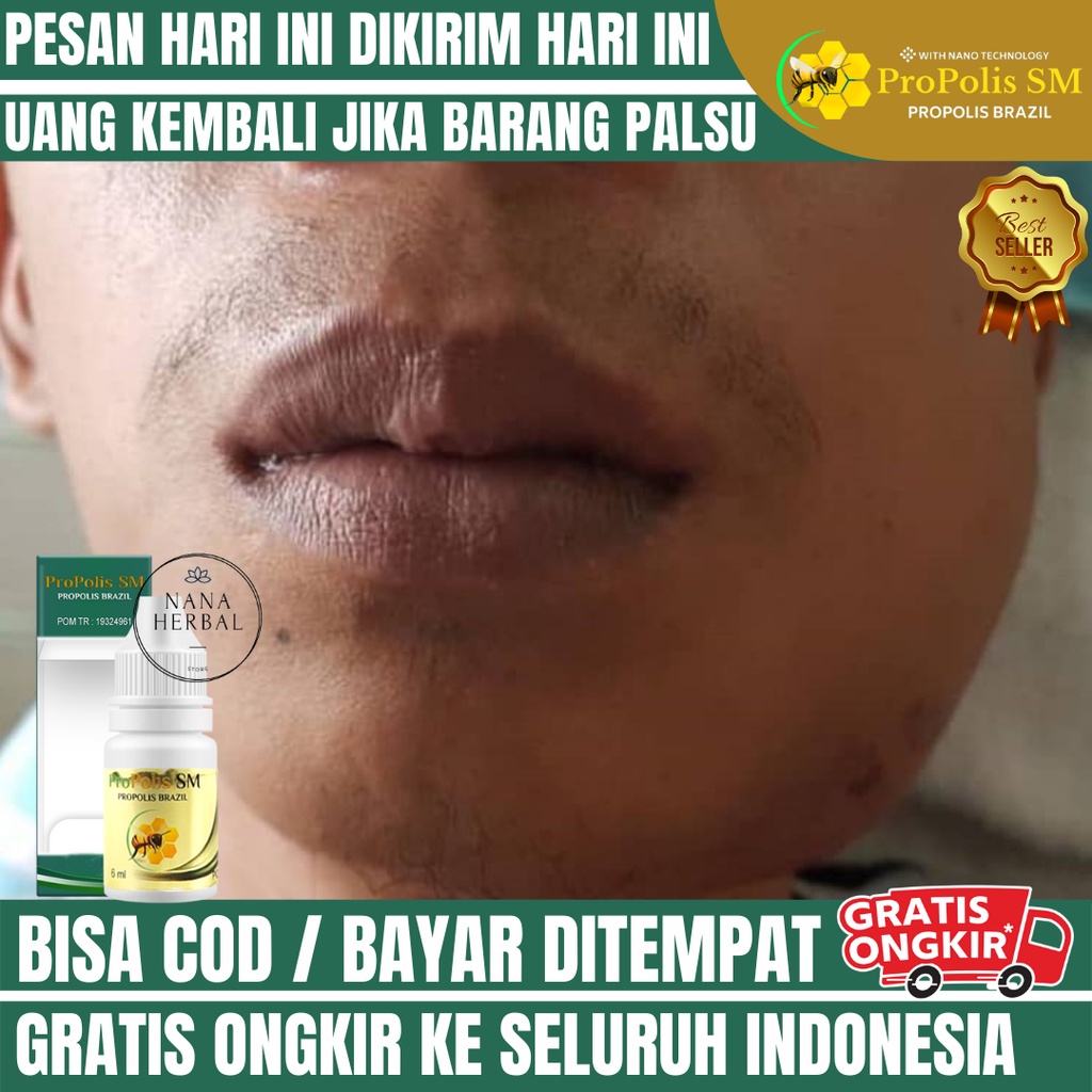 Obat Sakit Gigi Pipi Bengkak, Obat Gusi Bengkak, Obat Kumur Sariawan, Obat Sakit Gigi Nyut-Nyutan, O