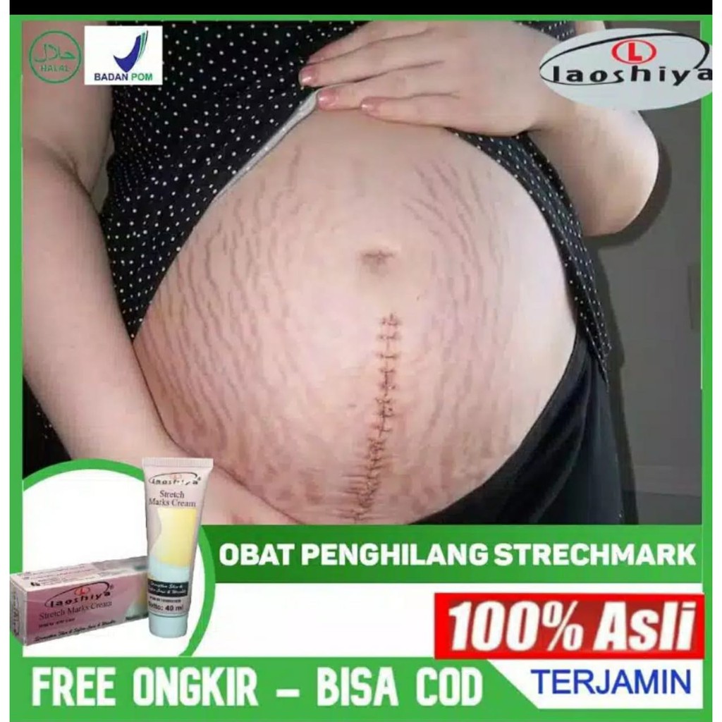 LAOSHIYA STRETCH MARKS CREAM BPOM - STRETCH MARKS LAOSHIYA ANTI SELULIT