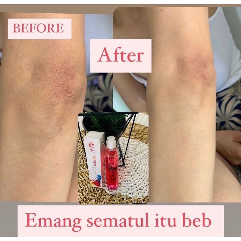 TONER BADAN YONI SKINCARE 100 ml / Toner Badan HALAL &amp; BPOM (Pemutih Badan, Penghilang Bekas Luka)