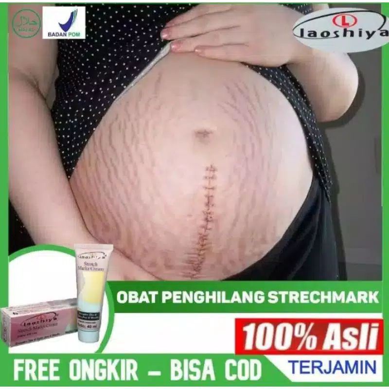 TERAMPUH Penghilang strechmark salep penghilang bekas luka penghilang keloid penghilang selulit