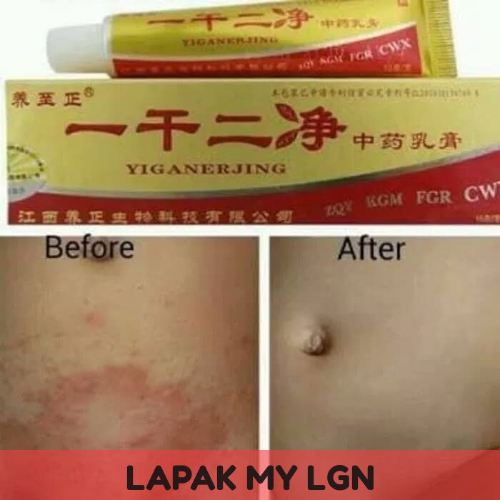 SALEP EKSIM KERING PADA KULIT KEPALA GATAL PADA KULIT KEPALA