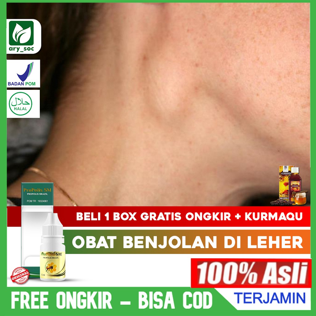 Obat Benjolan Di Leher - Obat Benjolan Di Leher TB Kelenjar - Kelenjar Getah Bening Propolis SM