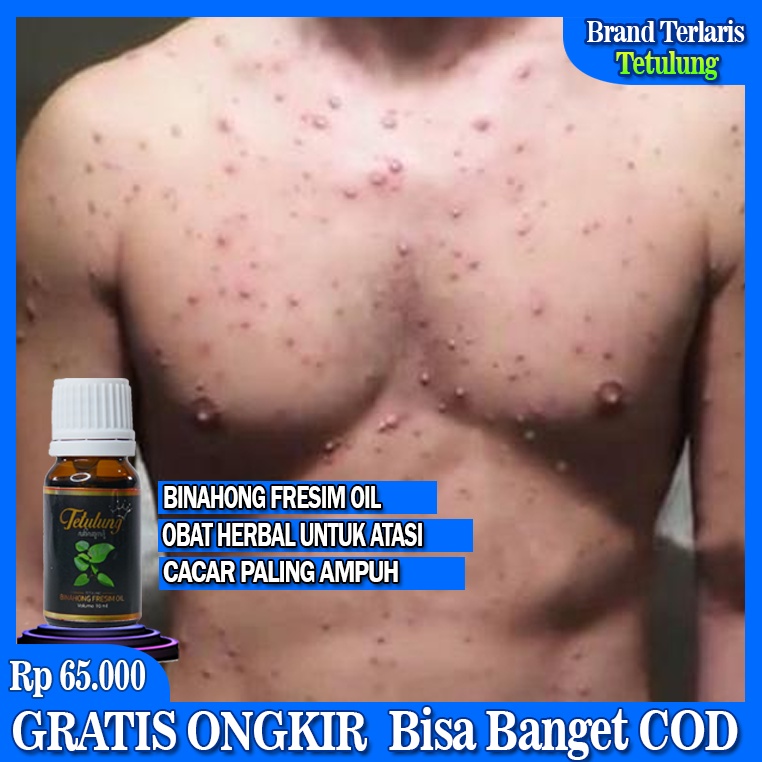 Obat Cacar, Obat Cacar Air, Obat Cacar , Obat Campak, Obat Gatal Berair, Obat Gatal Gatal, Obat Gudi