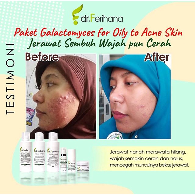 Galactomyces Day Cream For Oily &amp; Acne - Prone Skin DR. FERIHANA COSMETICS &amp; SKINCARE Krim Siang untuk Mengatasi Kulit Berminyak Berjerawat Bekas Jerawat Mencerahkan Sekaligus Anti Aging BPOM LPPOM HALAL MUI