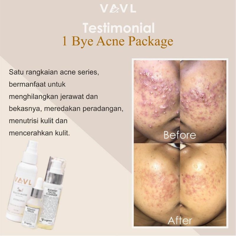 Valv Beauty Bye Acne Package Vavl Beaute Perawatan Wajah Jerawat