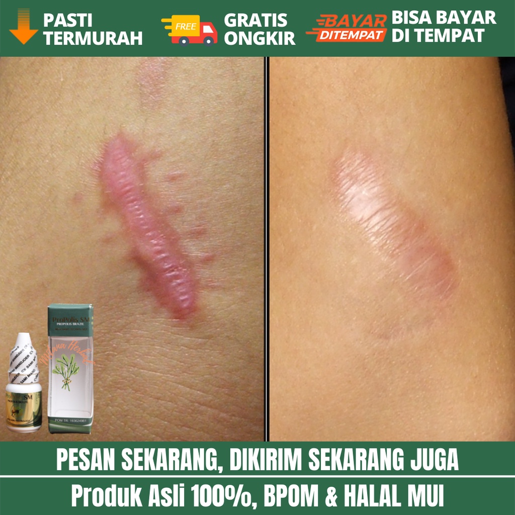 Jual Propolis Sm Obat Penumpas Daging Jadi Obat Penumpas Daging Tumbuh Obat Keloid Obat 3887