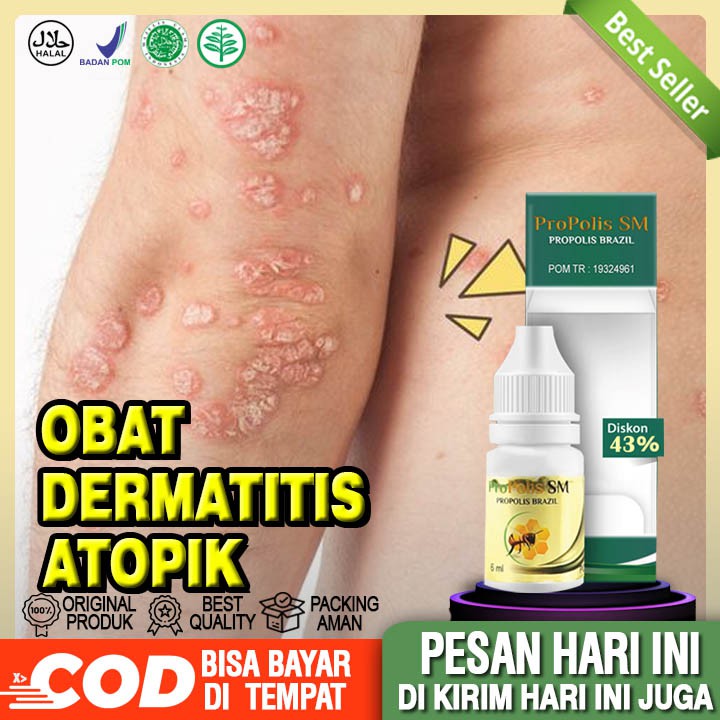 Obat Dermatitis Atopik, Gatal, Gatal Eksim, Eksim Basah, Eksim Kering