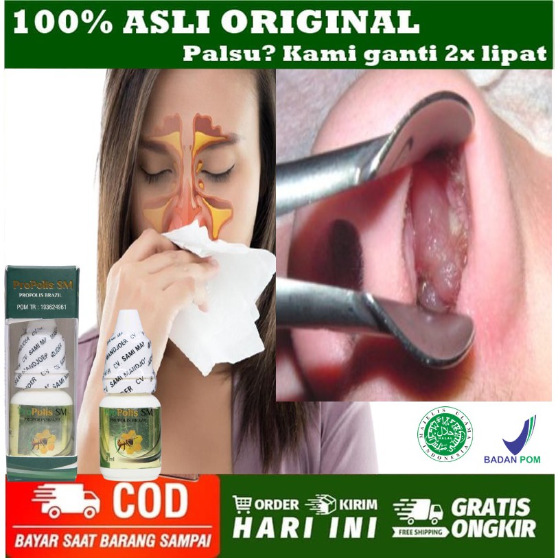 Obat tetes Polip Hidung - Hidung Berlendir Bau Busuk - Obat Sinusitis Kronis - Obat Hidung tersumbat - Obat Pilek Menahun - Obat Bersin Terus - Obat Hidung Mampet - oBta Anosmia Hilang Penciuman - Obat Benjolan dalam hidung - Obat hidung Berlendir-1