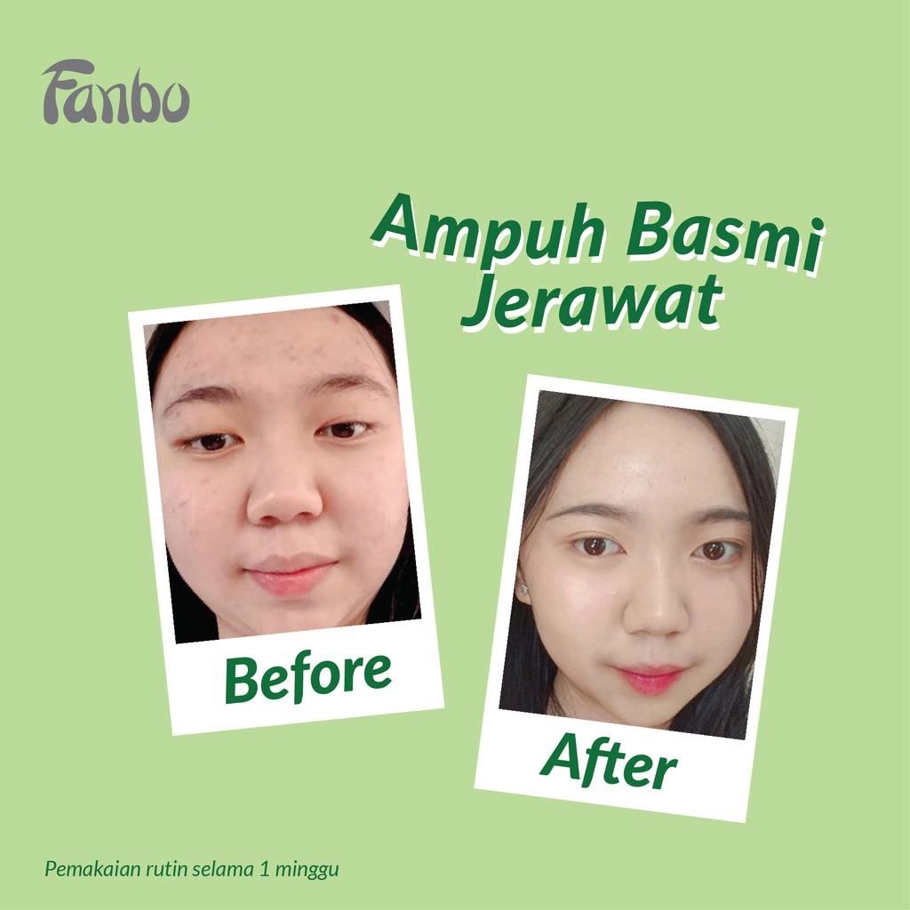 ★ BB ★ Fanbo Acne Solution Moisturizer Gel 40ml - Melembabkan dan Menyamarkan Bekas Jerawat - Noda Hitam