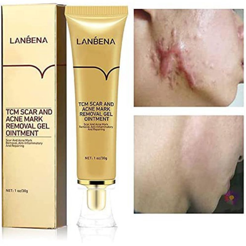 LABENA TCM SCAR ACNE Krim Ampuh Menghilangkan Belas Luka bakan Bekas Operasi Bekas Jerawat / Krim Penghilang  Bekas Luka Bakar