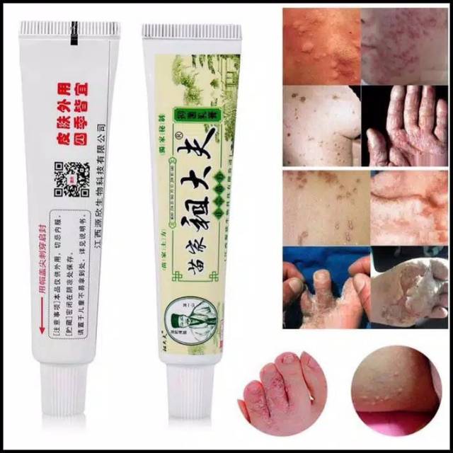 Salep Gatal Ampuh 100% / Obat Gatel  Herbal / obat gatal menahun / Obat eksim , Psoriasis , Rosacea-1