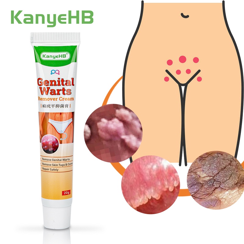 [Privasi Terjaga] KanyeHB Obat Kutil kelamin HPV Perontok Kutil Kelamin Pria / Wanita Salep Kutu Pubis Kelamin Penghilang Kutu Kelamin Genital Wart Remover -20gr