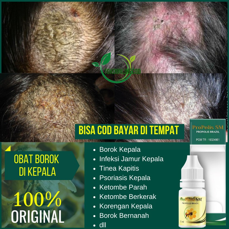 Obat Borok Kepala Infeksi Jamur Kulit Kepala Tinea Capitis Korengan Propolis Brazilian Sm Shopee Indonesia