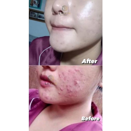 LASKIN PAKET ACNE GLOW SERIES ( FREE POUCH )-7