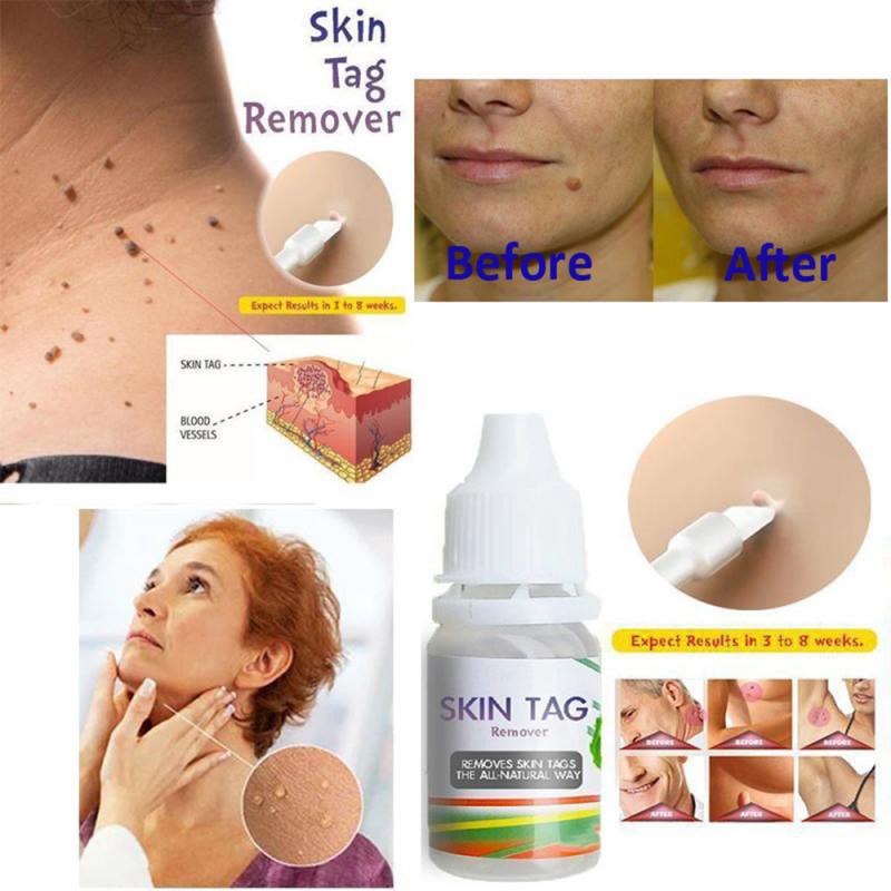 [100% Efektif] Obat Penghilang Tahi Lalat Obat Kutil Obat Kutil Kelamin Skin Taq Remover 10 ml