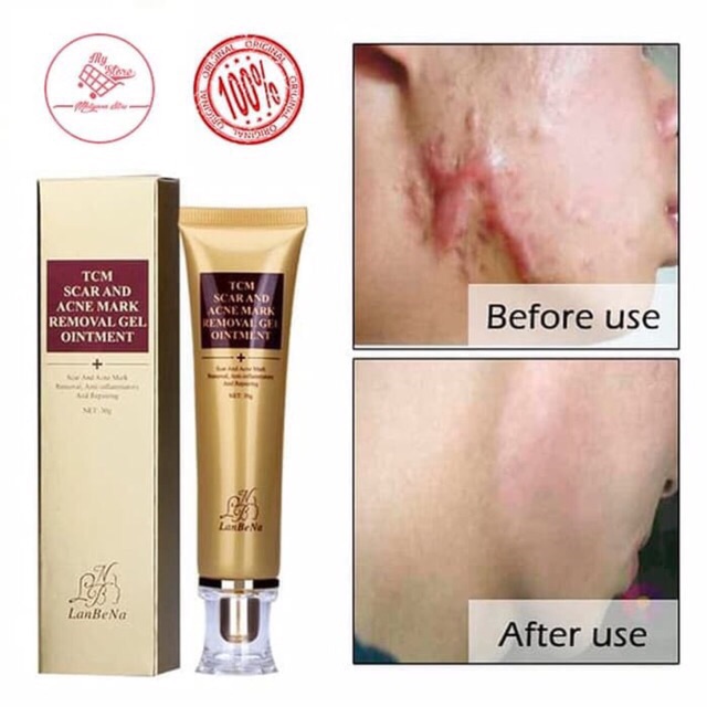 Penghilang Bekas Luka TCM LANBENA Scar and Acne Mark Removal Gel Ointment