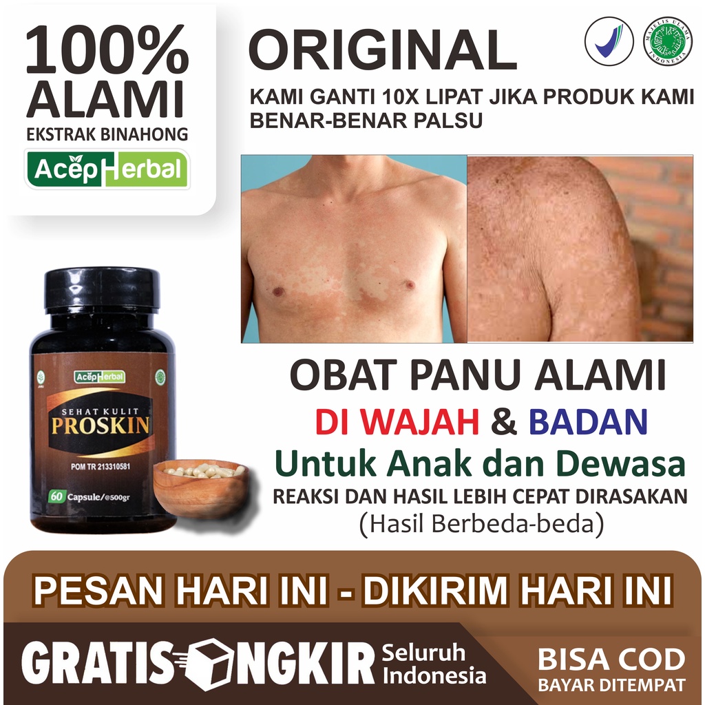 Obat Panu Gatal Jamur Kulit di Wajah Pipi Paling Alami Menghilangkan Hapur Bercak Belang Putih Pungg