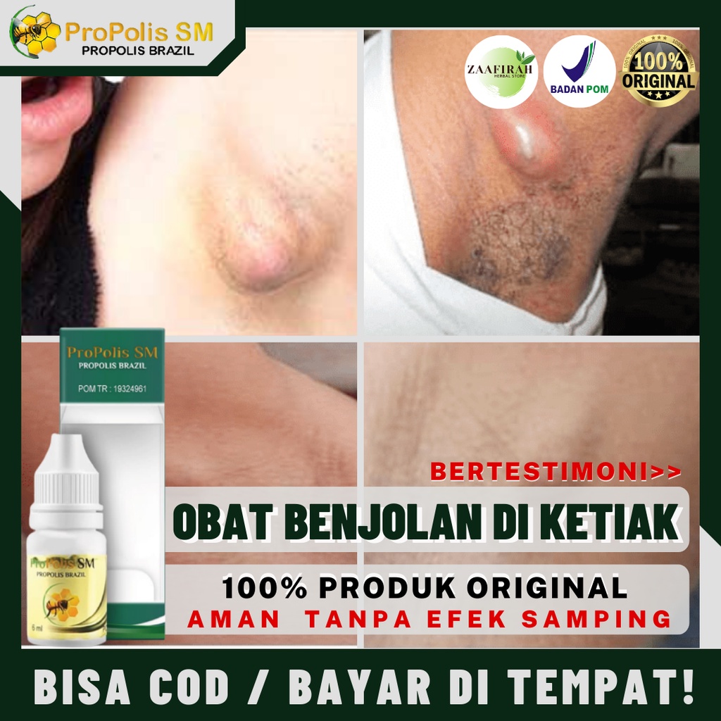 Benjolan Ketiak Lunak Keras Bisul Sekelan Kelenjar Getah Bening Lipoma Iritasi Lecet Perih Alergi De