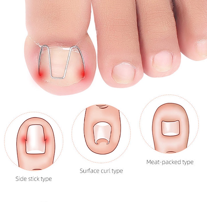 Alat Koreksi Kuku Kaki Tumbuh Ke Dalam Paronychia