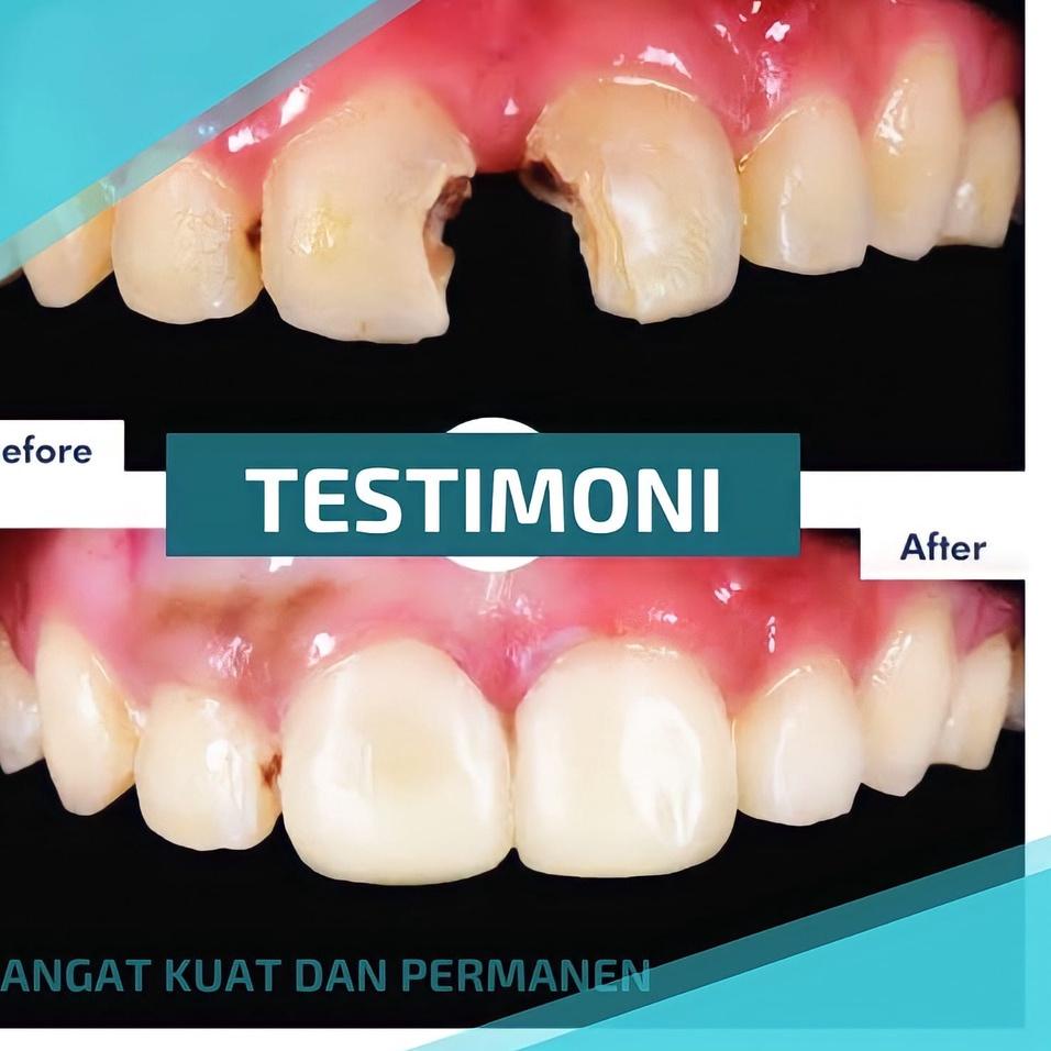 Hot - Penutup Gigi Berlubang Permanen Temtooth Tambal Gigi PALING KUAT 100% ORIGINAL Gigi Palsu Penu