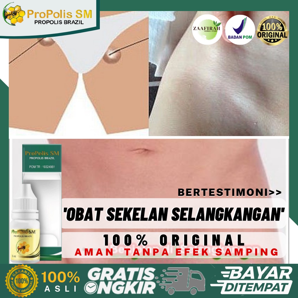 Obat Oles Sekelan Di Selangkangan - Benjolan Di Selangkangan - Benjolan Di Paha - Penghilang Sekelan