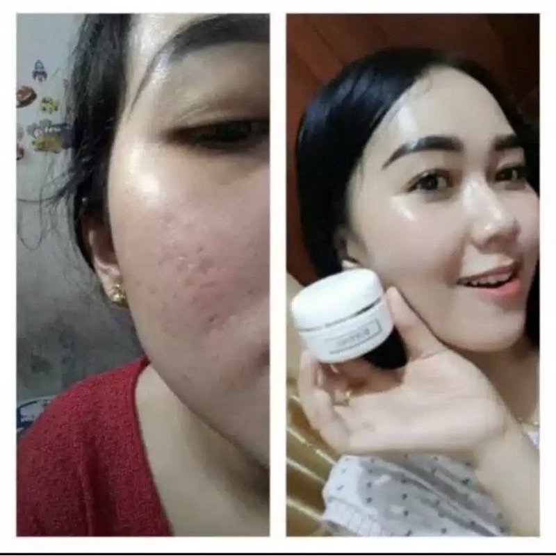 Cream Bopeng Scar Pori Cream Wajah Ampuh Original aman