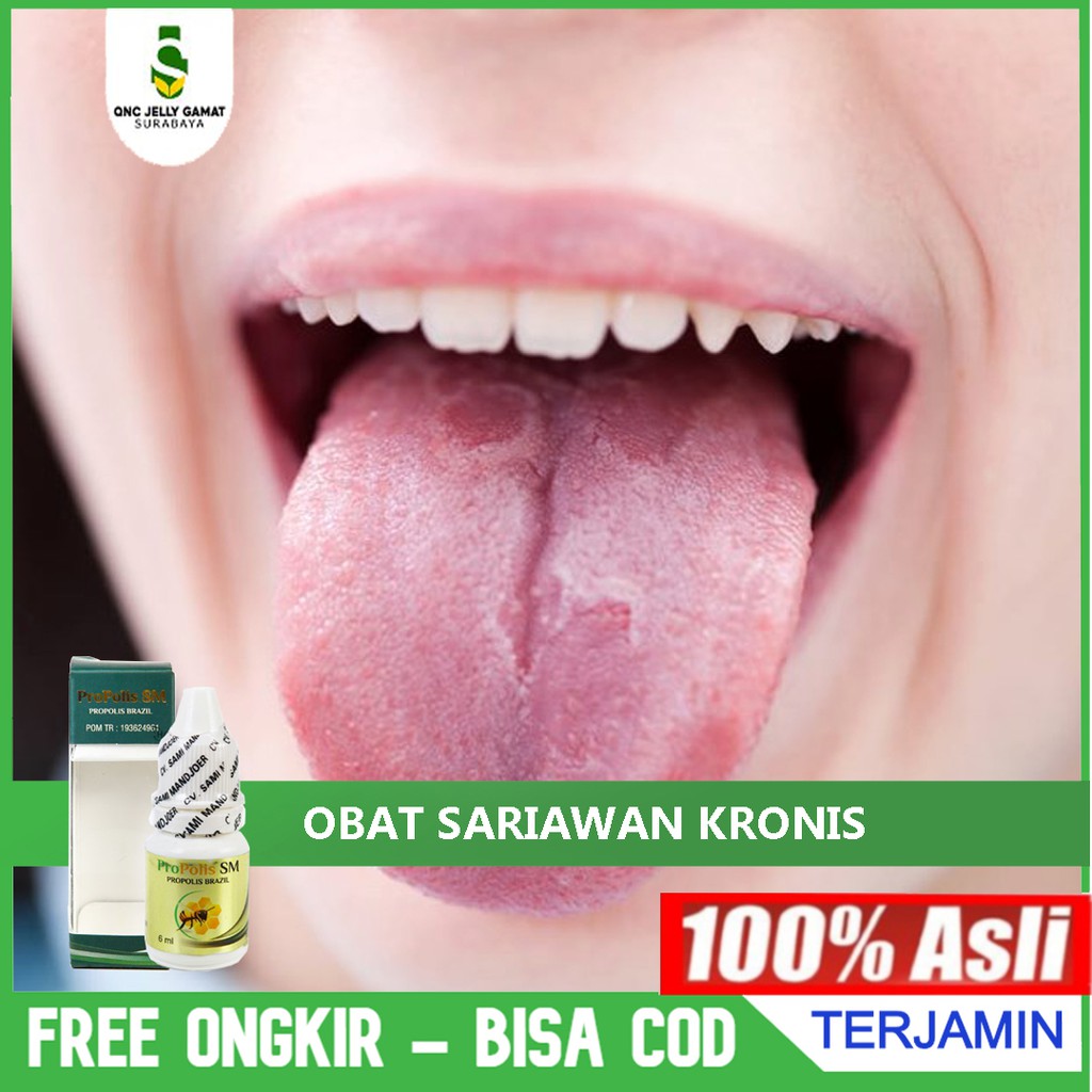 Obat Sariawan Kronis Akut Sariawan Yang Lama Sembuh Herbal Propolis Sm Asli Bisa Cod Halal Shopee Indonesia