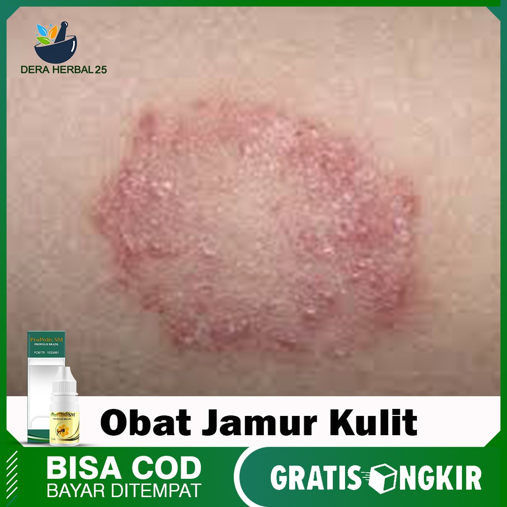 Obat Herbal Jamur Kulit, Kurap, Kudis, Kulit Eksim, Borok, Alergi Atasi Dengan Propolis Sm 100% Orig