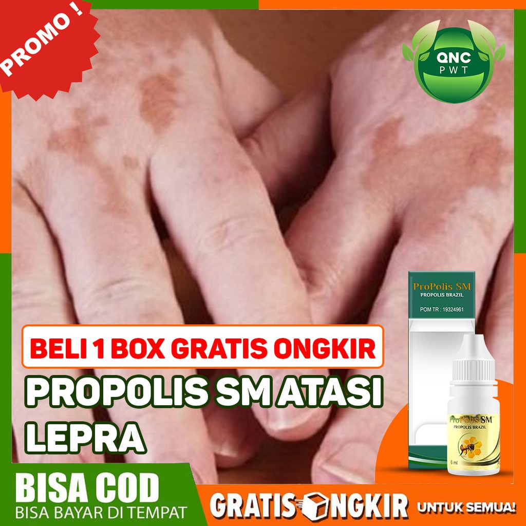 

Obat Lepra - Penyakit Kulit - Kusta Kering - Basah 100% Herbal Alami Propolis SM Bisa COD Di Solo