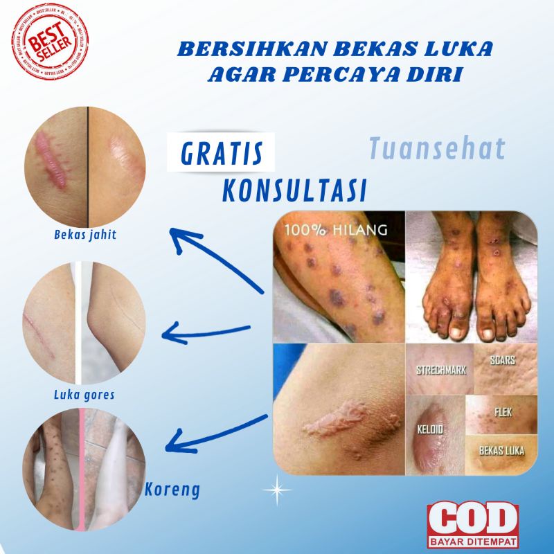 PENGHILANG BEKAS LUKA KORENG / KUDIS / STRECHMARK / FLEK / SCARS / KELOID (CHITIN - CHITOSAN)