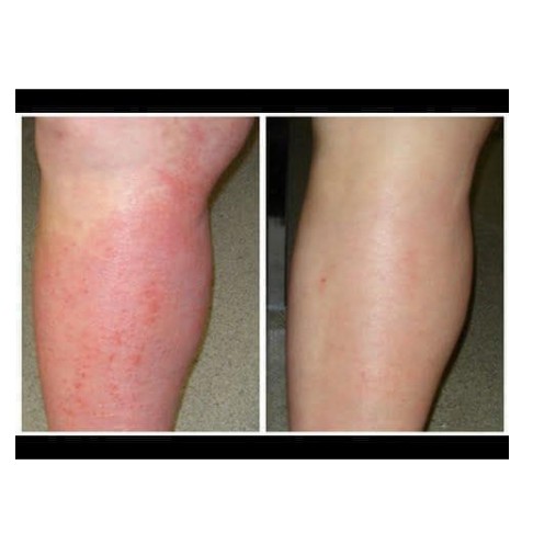 Obat Salep Gatal Gatel Kulit Kurap Jamur Bakteri Zudaifu Herbal-3