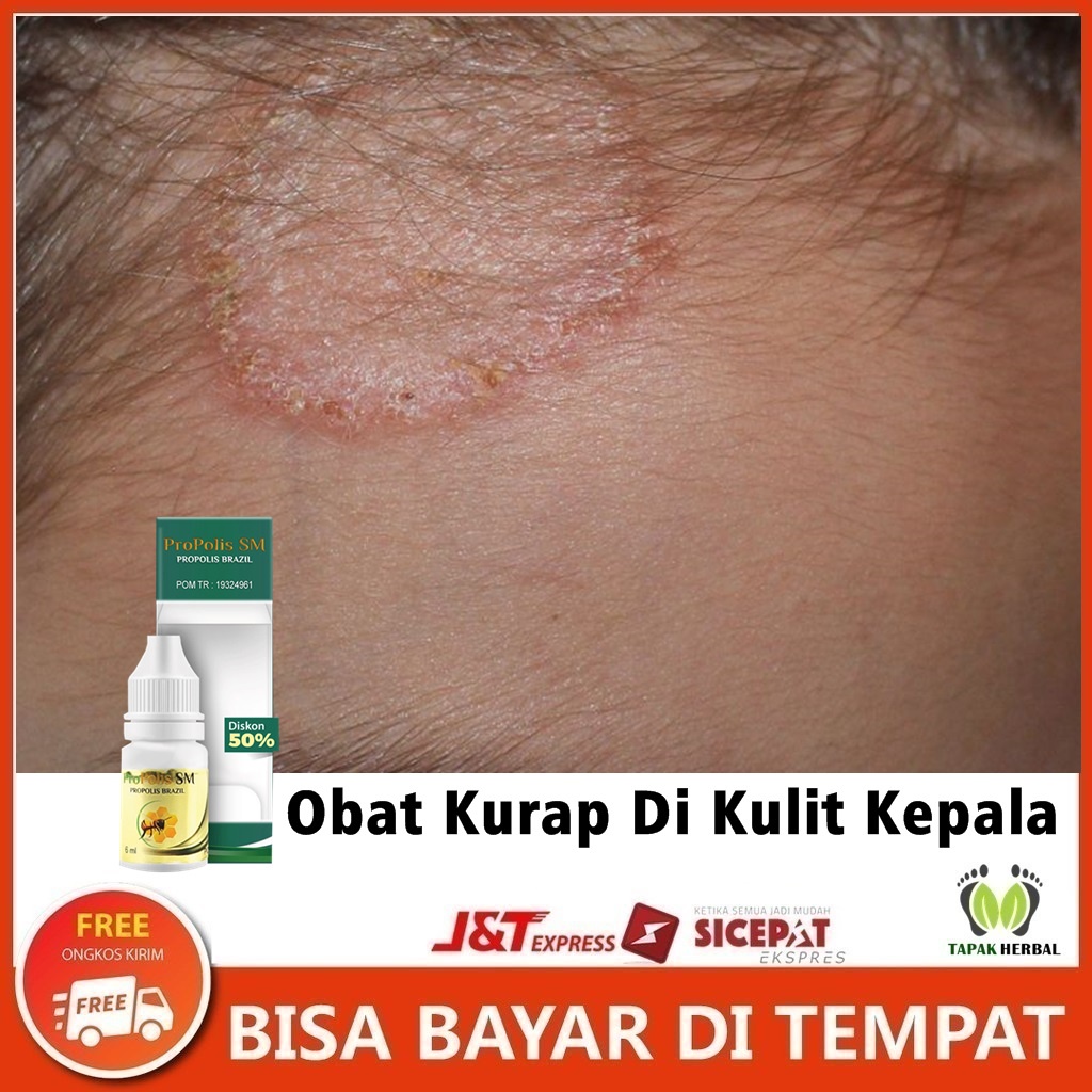 Obat Kurap Di Kulit Kepala, Obat Herbal Kepala Berkerak, Obat Infeksi Jamur Di Kepala, Obat Gatal Ku